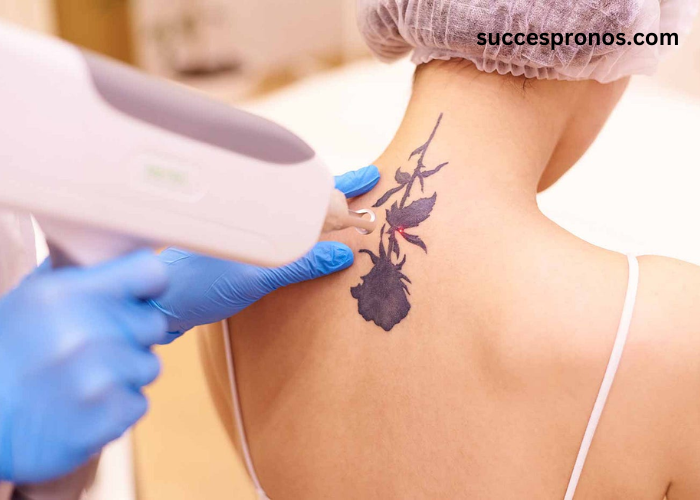 Key Factors to Consider Before Getting Laser Tattoo Removal in Dubai