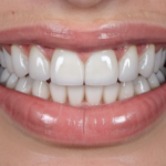 Bring Your Bright And Shiny Smile Back With Veneers